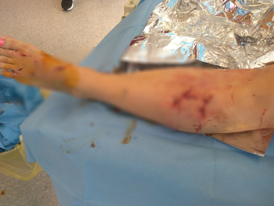 Καλαμάτα: «Φοβήθηκα για τη ζωή μου, με κατασπάραξαν» λέει η 34χρονη που δέχθηκε επίθεση σκύλων στην Καλαμάτα