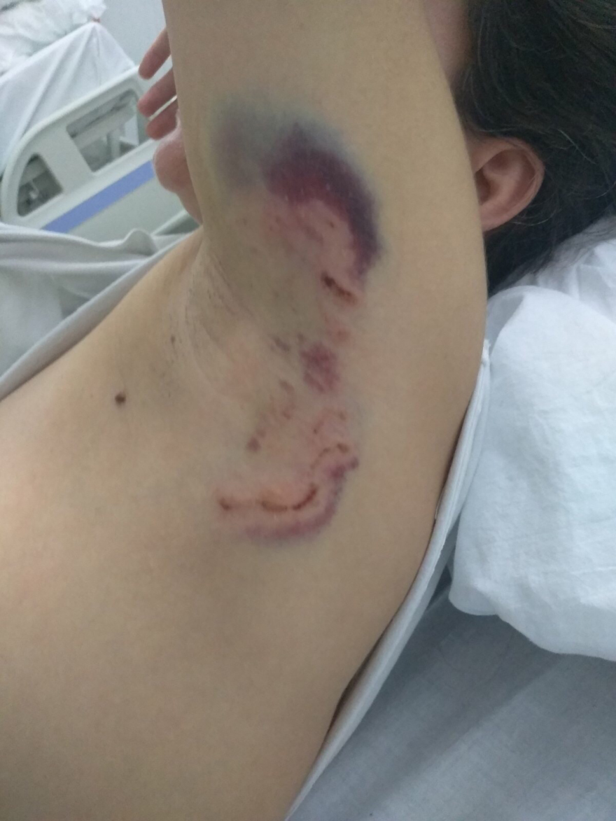 Καλαμάτα: «Φοβήθηκα για τη ζωή μου, με κατασπάραξαν» λέει η 34χρονη που δέχθηκε επίθεση σκύλων στην Καλαμάτα