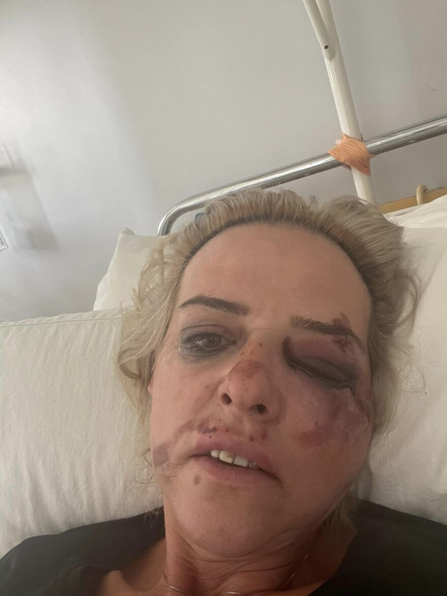 Καλαμάτα: «Έπεσα από τη μηχανή και μου όρμησαν τα σκυλιά» - Μιλά το θύμα της νέας επίθεσης από αδέσποτα