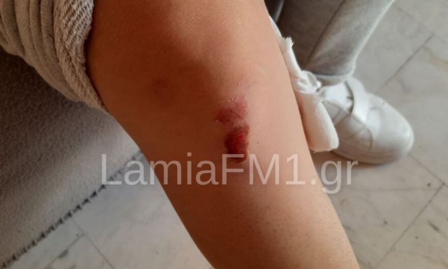 Λαμία: «Mε άρπαξε και με χτυπούσε στο πεζοδρόμιο» λέει η 35χρονη που δέχτηκε επίθεση σκύλου