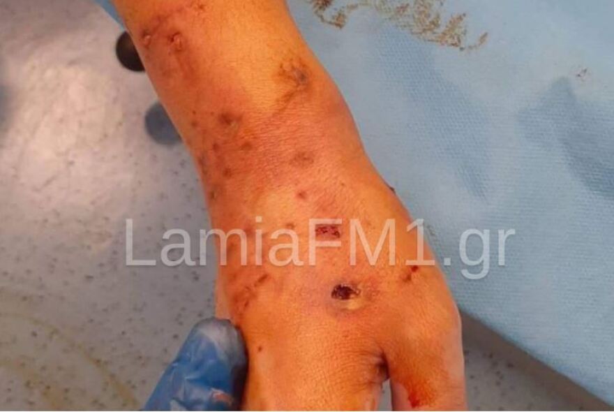 Λαμία: «Mε άρπαξε και με χτυπούσε στο πεζοδρόμιο» λέει η 35χρονη που δέχτηκε επίθεση σκύλου