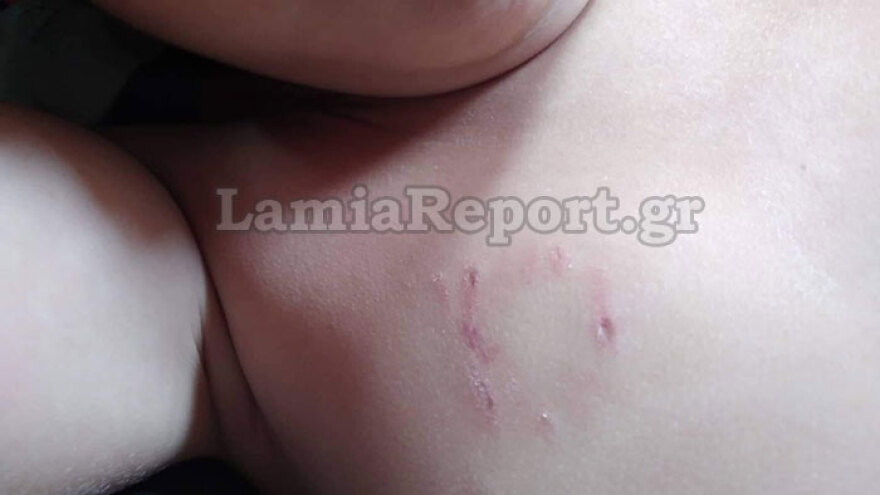 Λαμία: Επίθεση σκύλου σε παιδί - «Σήκωσα τη μπλούζα του και τα έχασα» λέει η μητέρα του