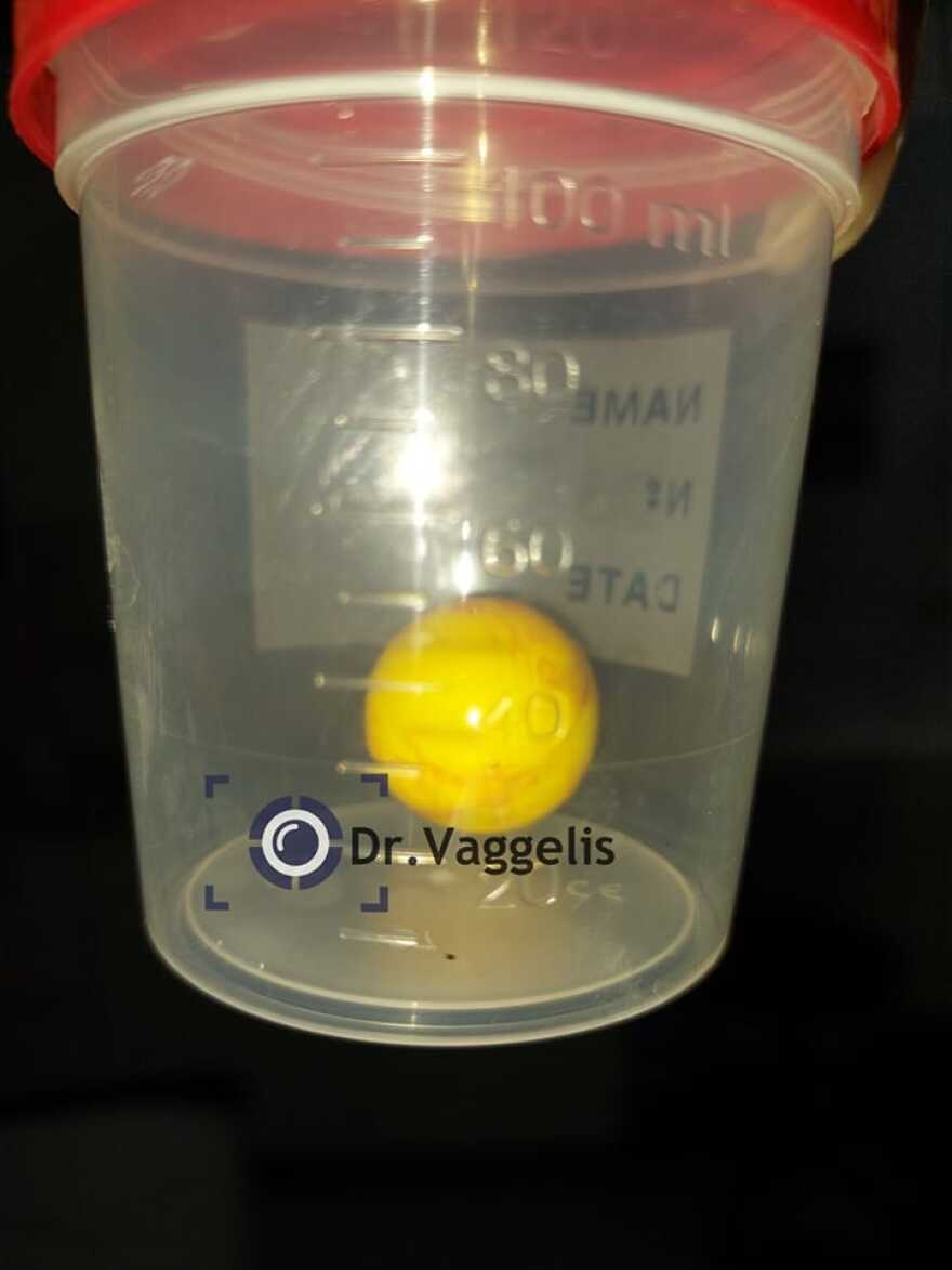 Αμαλιάδα: «Για λίγα δευτερόλεπτα σώθηκε» λέει γιατρός για το βρέφος που κατάπιε μπαλάκι