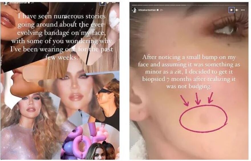 Κλόε Καρντάσιαν: Αφαίρεσε όγκο από το πρόσωπό της - «Ευγνώμων που το κατάλαβα νωρίς»