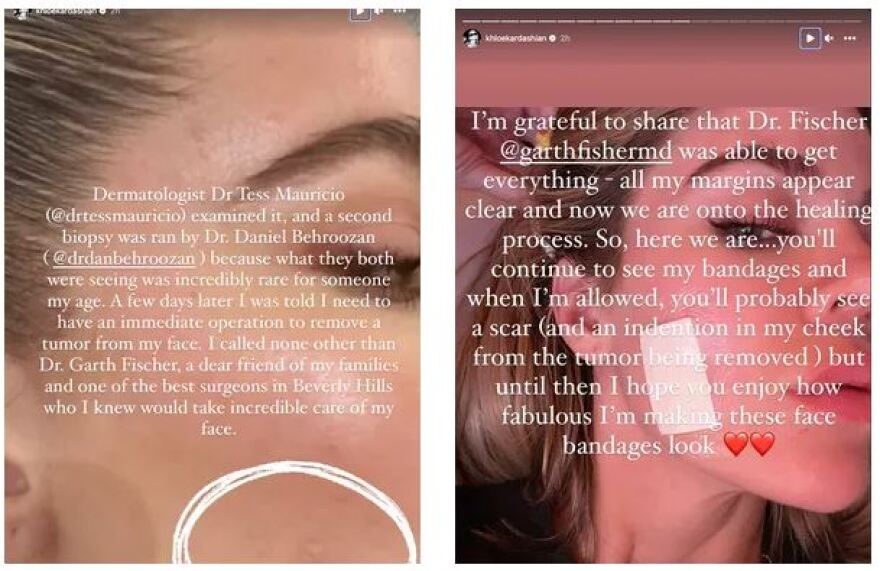 Κλόε Καρντάσιαν: Αφαίρεσε όγκο από το πρόσωπό της - «Ευγνώμων που το κατάλαβα νωρίς»