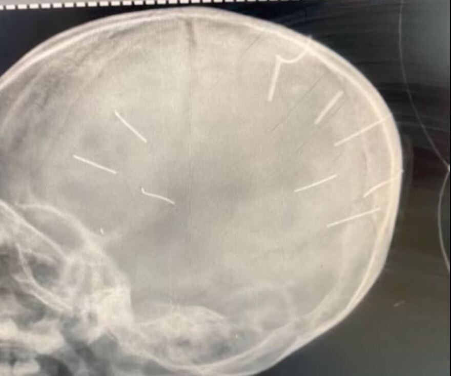 Σκότωσε την 3χρονη κόρη της συντρόφου του τρυπώντας το κεφάλι της με καρφιά