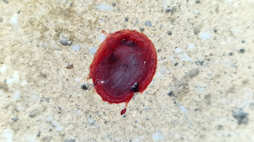 Θεσσαλονίκη: Δεν είναι πλαστικός χειρουργός ο γιατρός που χτυπήθηκε με λοστό στο κεφάλι