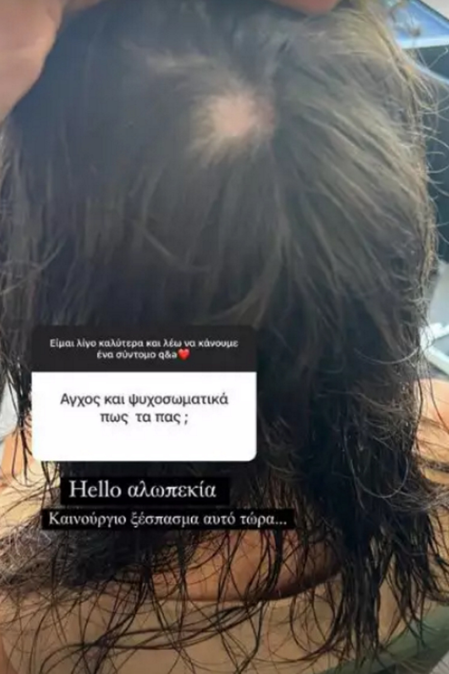 Χαρά Παππά: Αποκάλυψε πως πάσχει από αλωπεκία