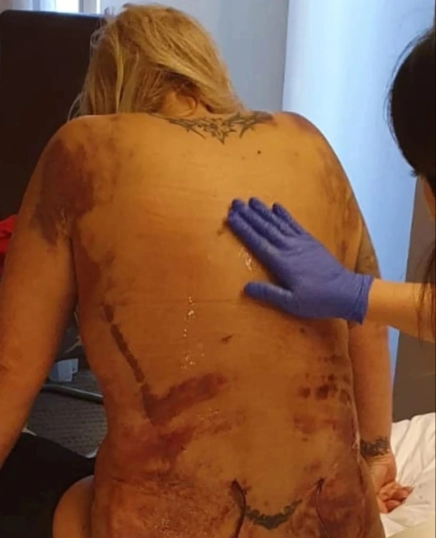 Εφιάλτης για Βρετανίδα στην Τουρκία - Πήγε για λιποαναρρόφηση και παραλίγο να πεθάνει