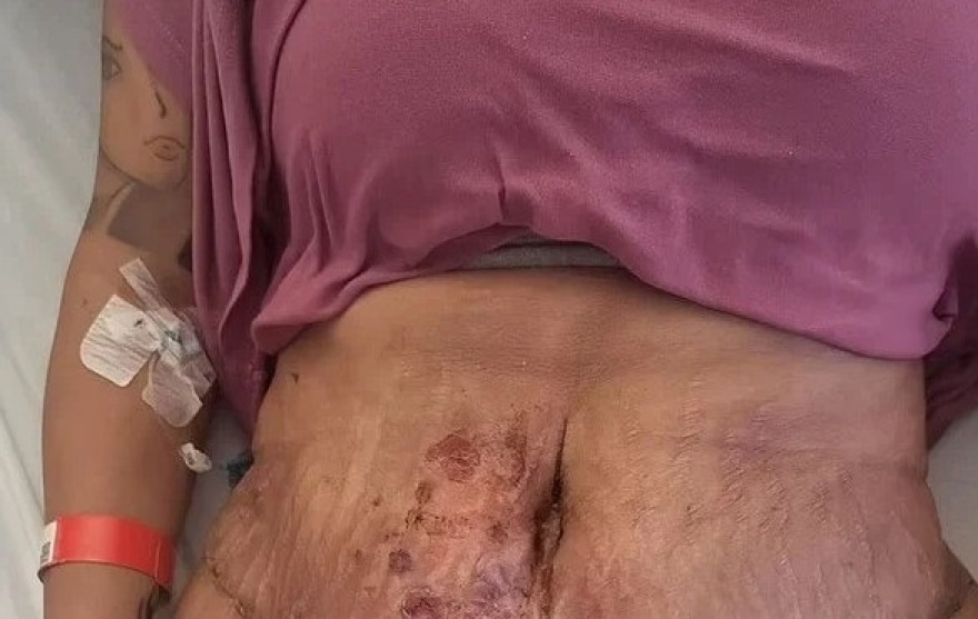 Εφιάλτης για Βρετανίδα στην Τουρκία - Πήγε για λιποαναρρόφηση και παραλίγο να πεθάνει