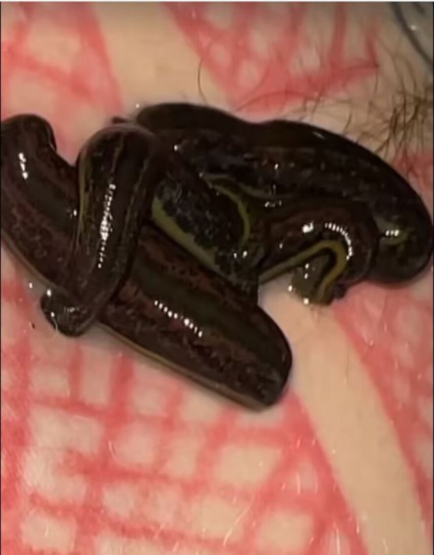 Μασίν Γκαν Κέλι: Έβαλε βδέλλες στο σώμα του