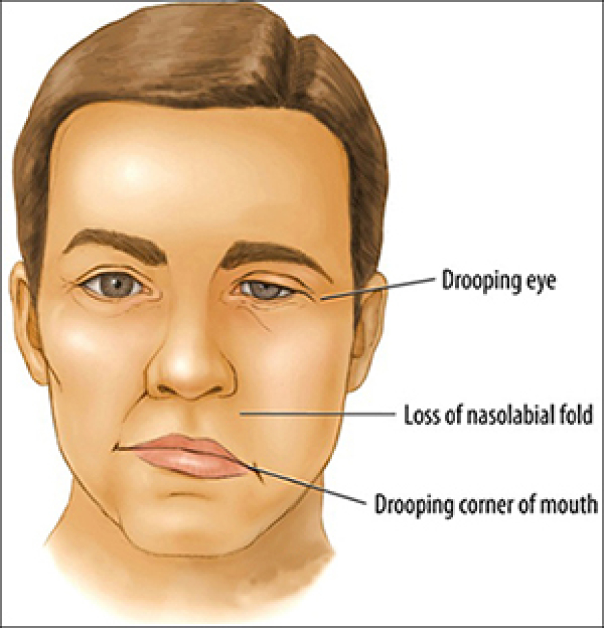 Τζορτζ Κλούνεϊ: Αποκάλυψε το πρόβλημα υγείας που του παρέλυσε το μισό πρόσωπο