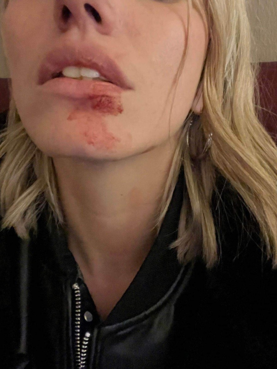 Γλυφάδα: Συγκλονίζουν οι φωτογραφίες από τα χτυπήματα που δέχτηκε το μοντέλο από τον dj πρώην της