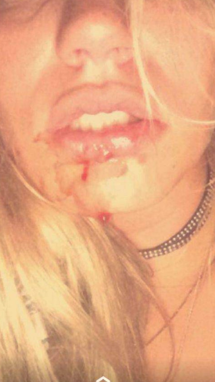 Γλυφάδα: Συγκλονίζουν οι φωτογραφίες από τα χτυπήματα που δέχτηκε το μοντέλο από τον dj πρώην της