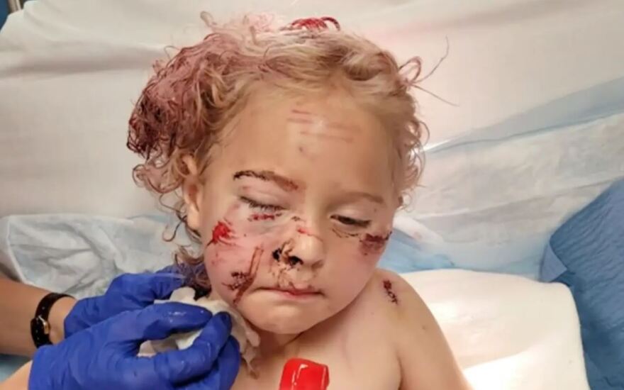 ΗΠΑ: 50 ράμματα σε 5χρονη μετά από άγρια επίθεση σκύλου στη Φλόριντα