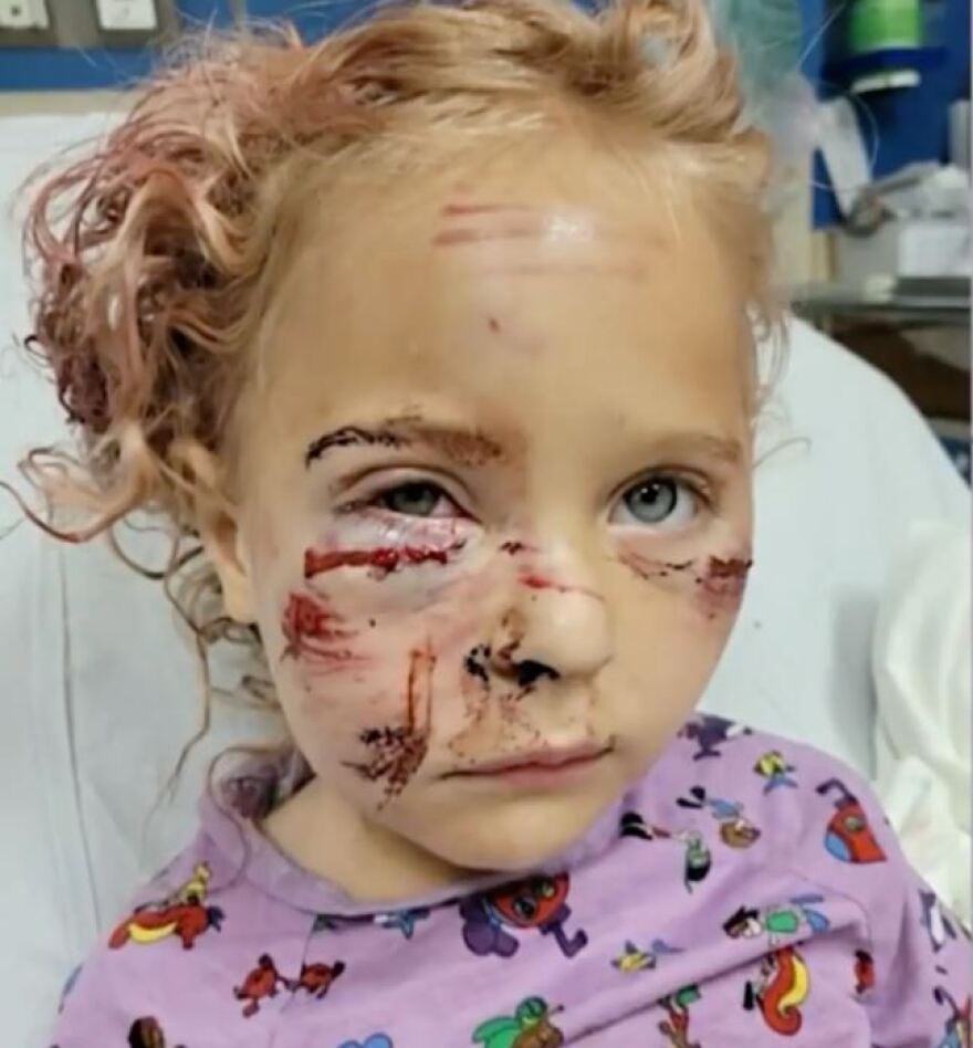 ΗΠΑ: 50 ράμματα σε 5χρονη μετά από άγρια επίθεση σκύλου στη Φλόριντα