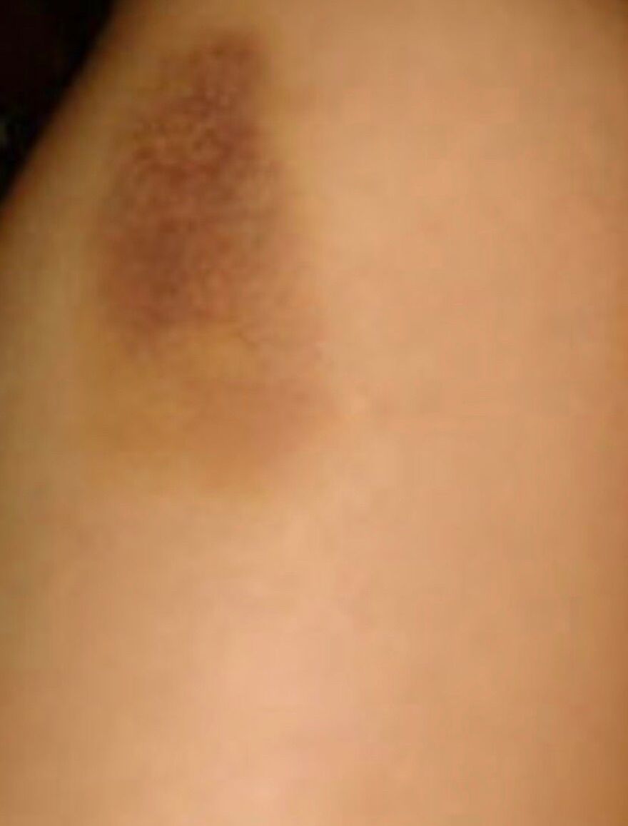 Βούλα: 43χρονη καταγγέλλει άγριο ξυλοδαρμό από τον επιχειρηματία πρώην σύζυγό της