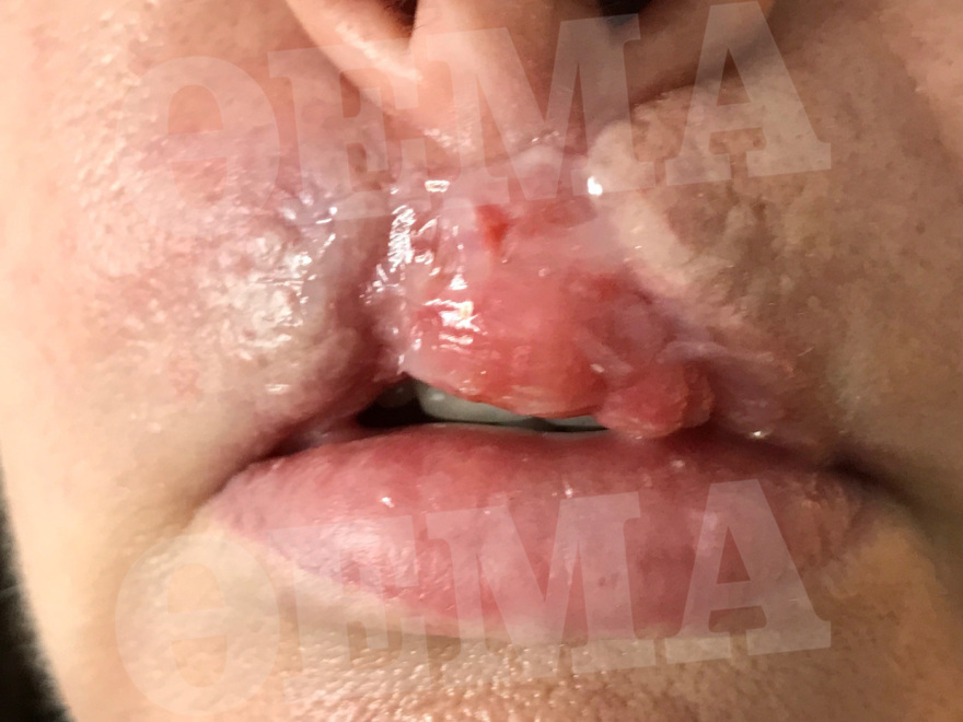 Ελληνίδα συγγραφέας είδε τα χείλη της να «σαπίζουν» μετά από πλαστική επέμβαση