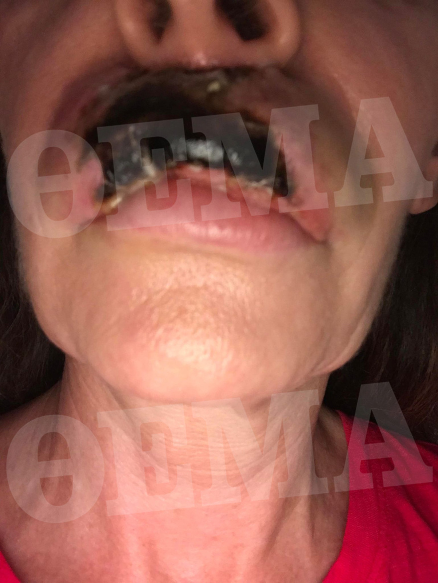 Ελληνίδα συγγραφέας είδε τα χείλη της να «σαπίζουν» μετά από πλαστική επέμβαση