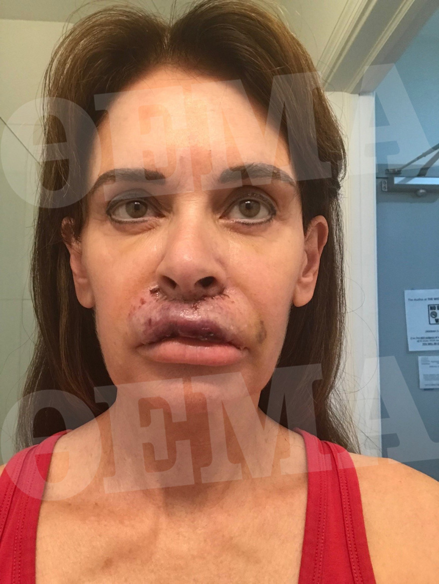 Ελληνίδα συγγραφέας είδε τα χείλη της να «σαπίζουν» μετά από πλαστική επέμβαση