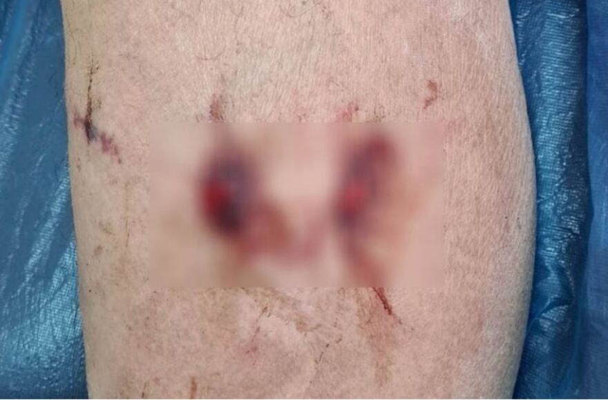 Αιτωλικό: Αδέσποτος σκύλος επιτέθηκε και τραυμάτισε 73χρονο - Δείτε φωτογραφία