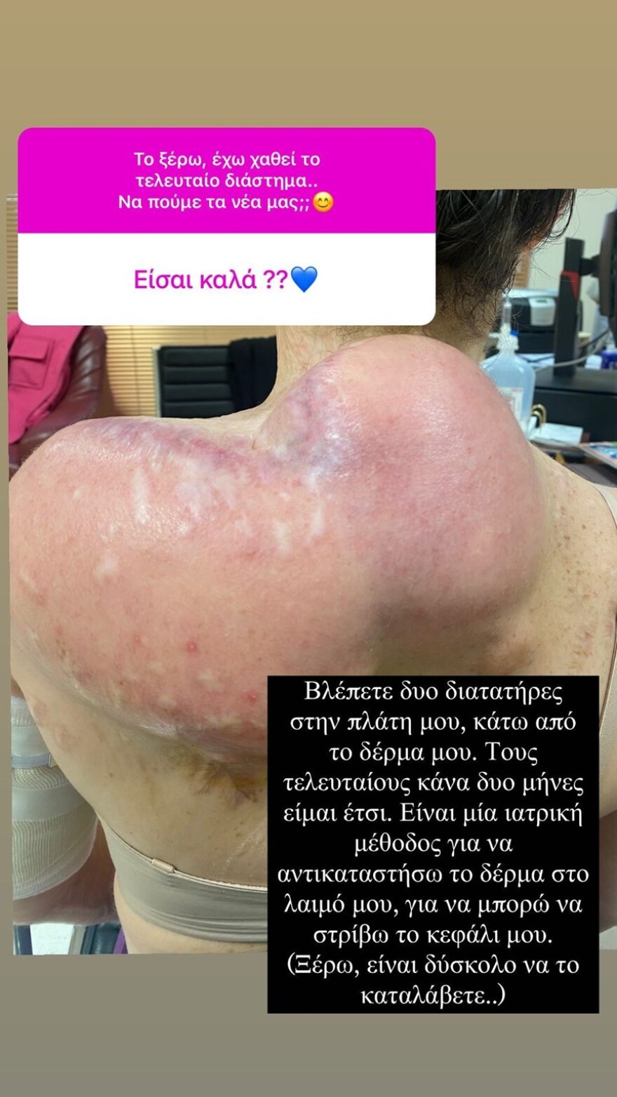 Ιωάννα Παλιοσπύρου: Η ιατρική μέθοδος για να αποκαταστήσει το δέρμα στον λαιμό της