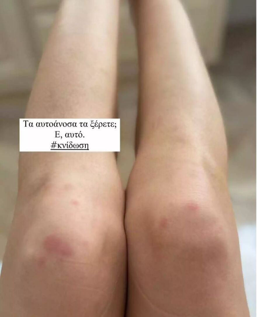 Γιάννα Τερζή: Αποκάλυψε το αυτοάνοσο νόσημα που την ταλαιπωρεί