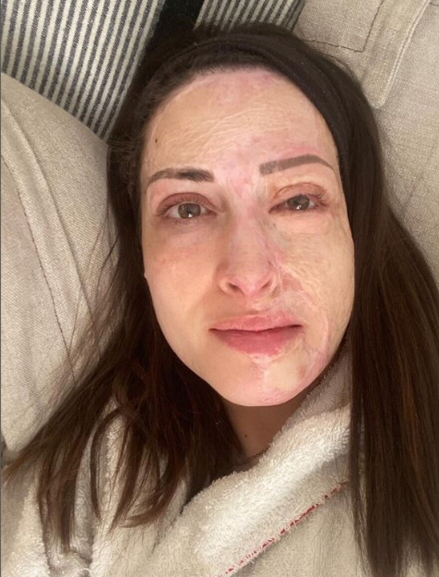 Ιωάννα Παλιοσπύρου: Δεν νιώθω μίσος και θυμό για τη γυναίκα που μου έριξε το βιτριόλι