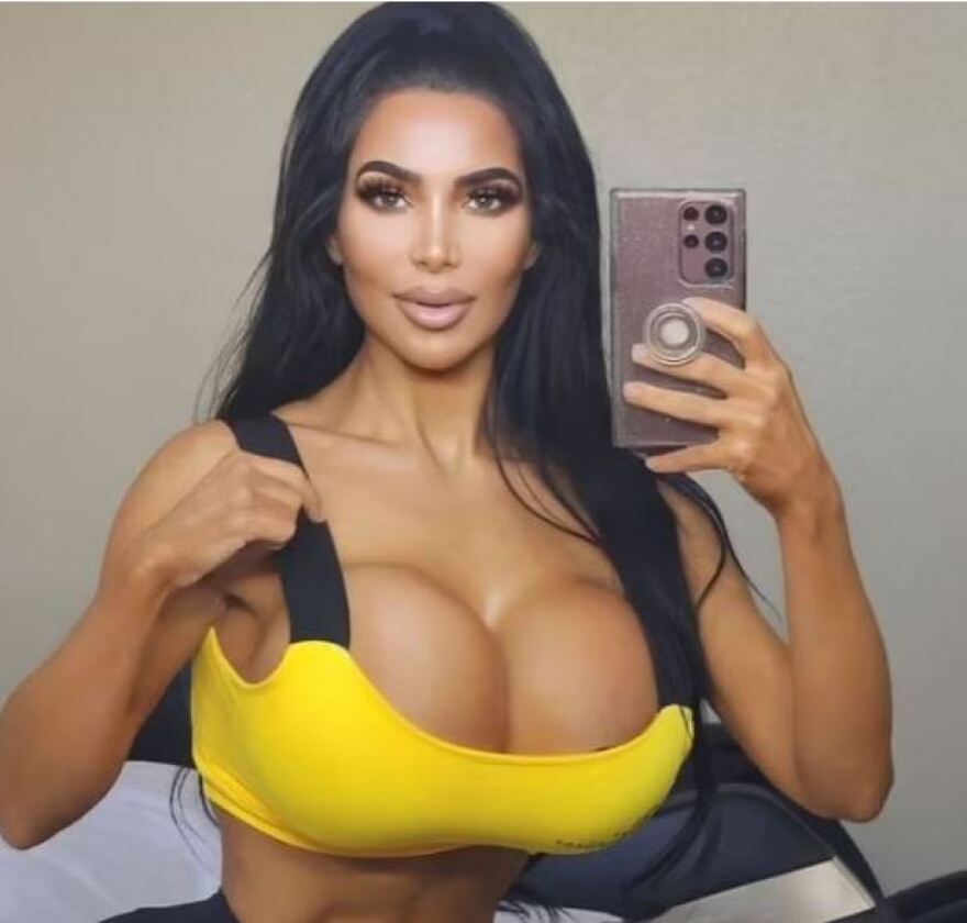 Σωσίας της Κιμ Καρντάσιαν και μοντέλο του Onlyfans πέθανε από ανακοπή μετά από πλαστική επέμβαση