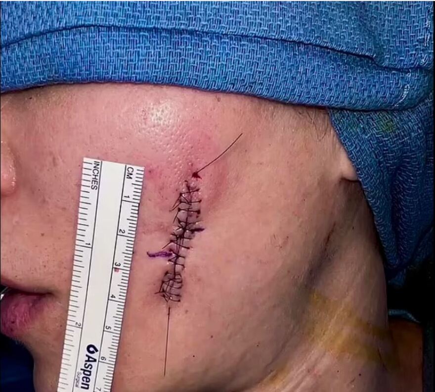 Κλόε Καρντάσιαν: Έδωσε φωτογραφίες από την τομή στο μάγουλό της - «Το μελάνωμα είναι θανατηφόρο»