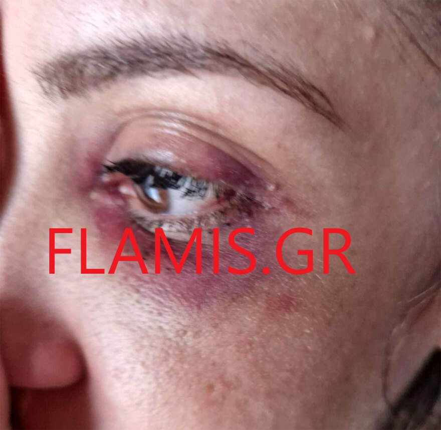 Πάτρα: «Θα σε σκοτώσω όταν βγω από τη φυλακή» - 31χρονη περιγράφει τον άγριο ξυλοδαρμό από τον σύντροφό της