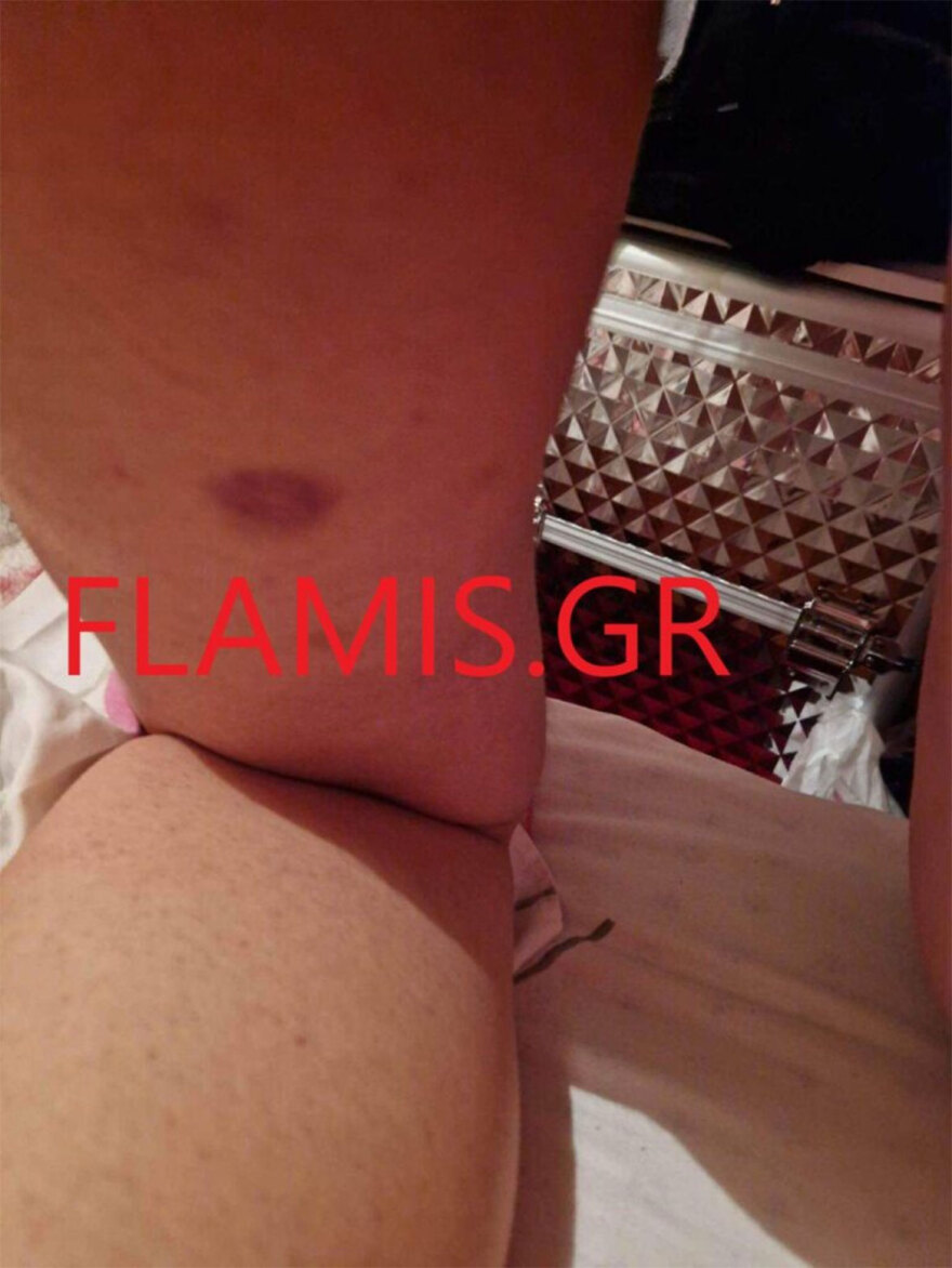 Πάτρα: «Θα σε σκοτώσω όταν βγω από τη φυλακή» - 31χρονη περιγράφει τον άγριο ξυλοδαρμό από τον σύντροφό της