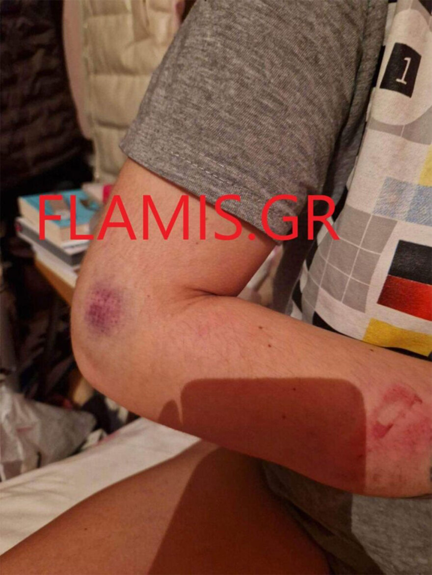 Πάτρα: «Θα σε σκοτώσω όταν βγω από τη φυλακή» - 31χρονη περιγράφει τον άγριο ξυλοδαρμό από τον σύντροφό της