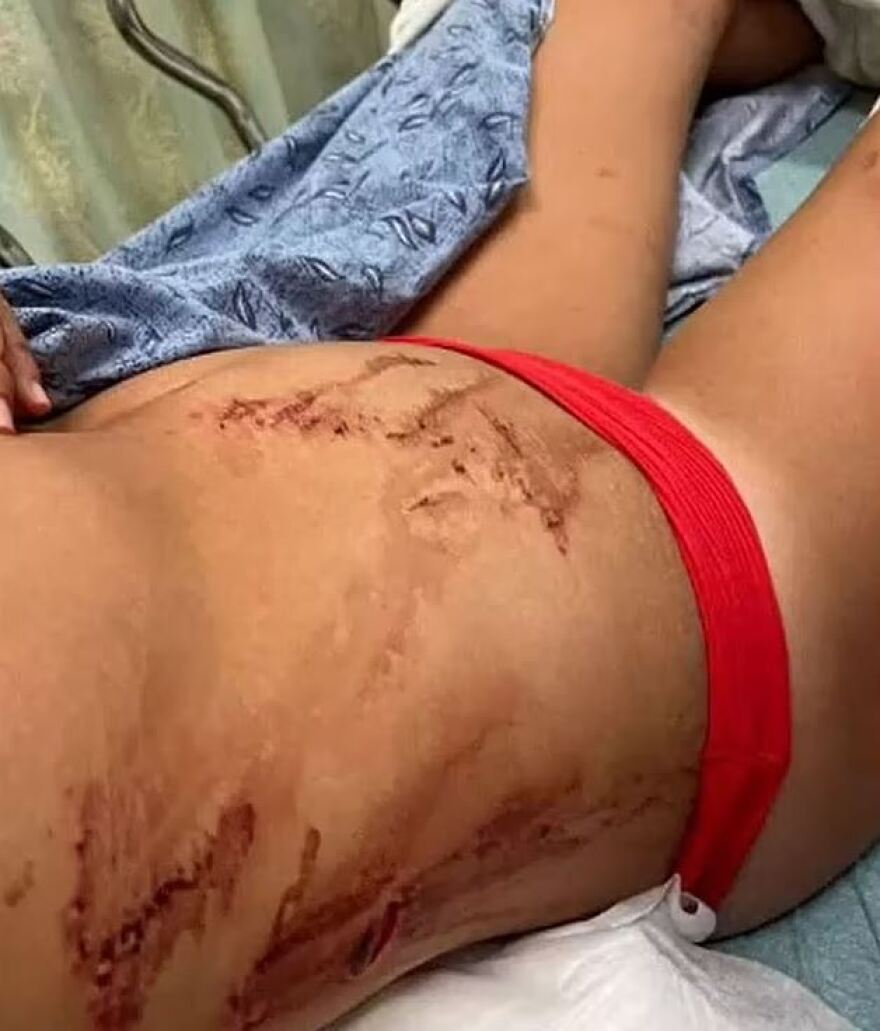 Φλόριντα: 13χρονη έδιωξε με γροθιά καρχαρία που της επιτέθηκε - Γλίτωσε με 19 ράμματα