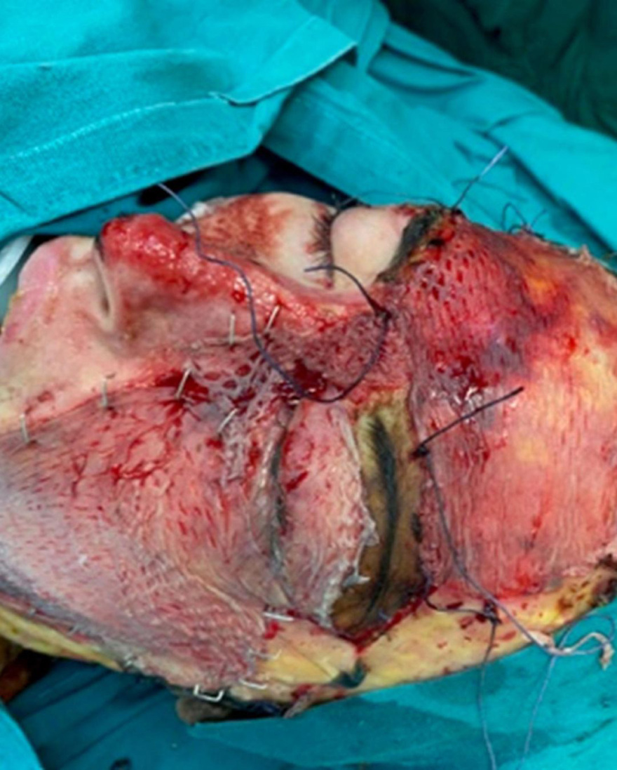 Ιωάννα Παλιοσπύρου: Η συγκλονιστική ανάρτηση με φωτογραφίες από τα χειρουργεία - Προσοχή σκληρές εικόνες