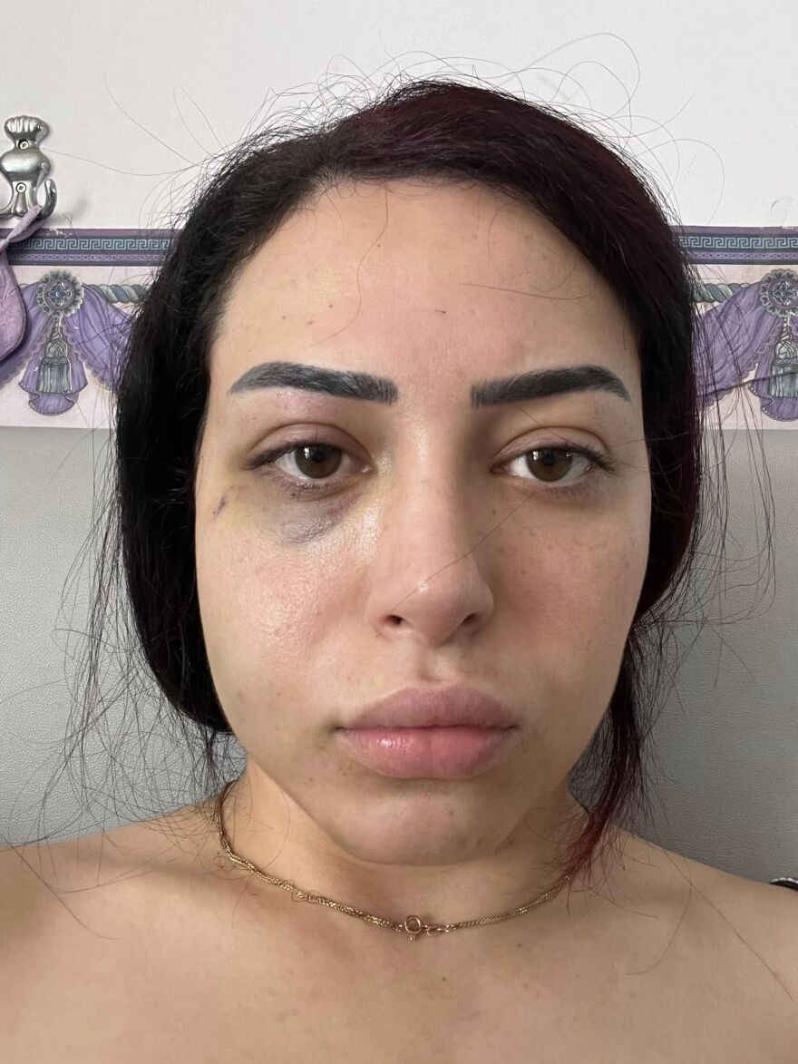 Αγία Νάπα: Νεαρή Τουρκοκύπρια καταγγέλλει Ελληνοκύπριους για επίθεση και ξυλοδαρμό (βίντεο και φωτογραφίες)