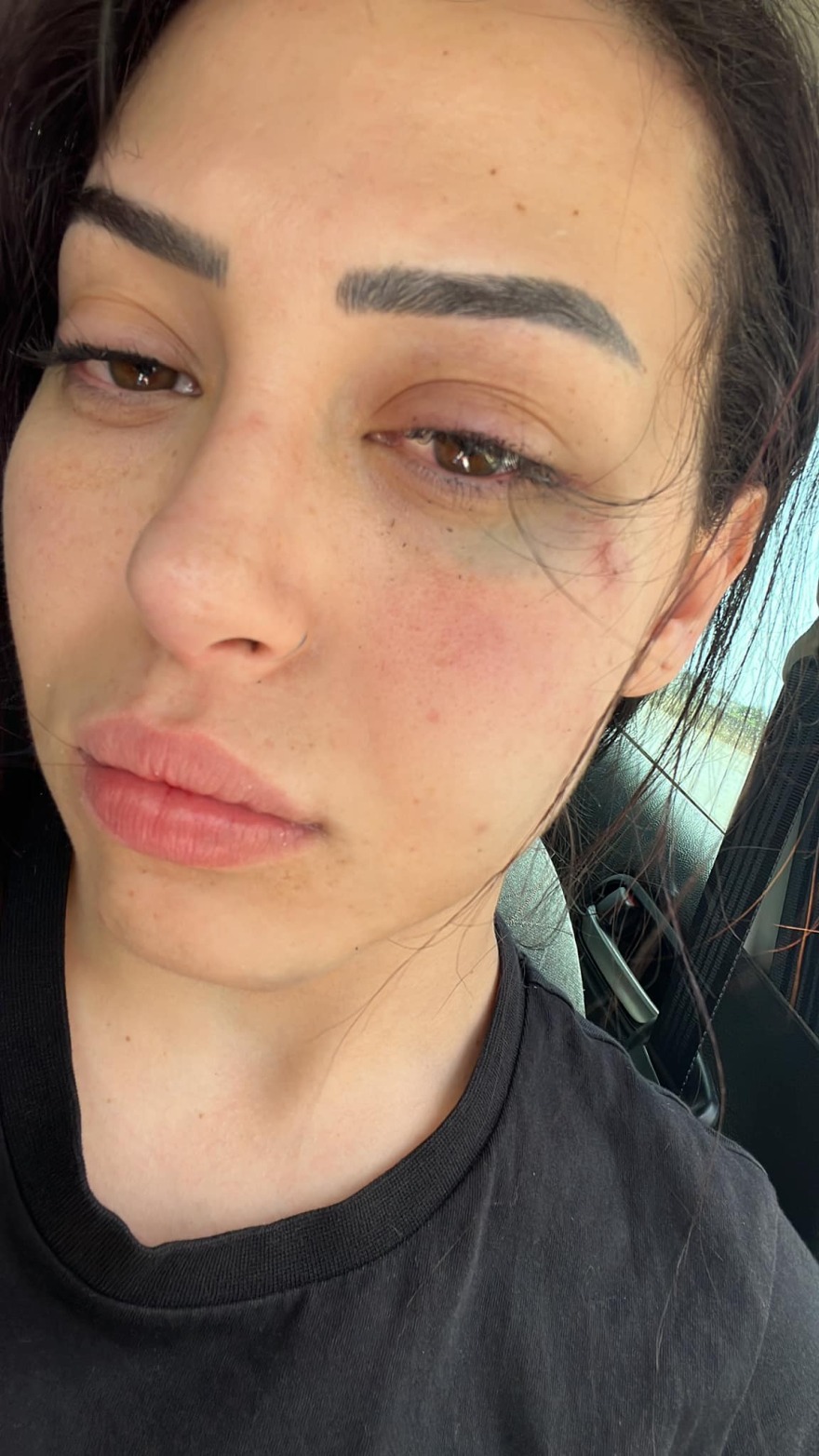 Αγία Νάπα: Νεαρή Τουρκοκύπρια καταγγέλλει Ελληνοκύπριους για επίθεση και ξυλοδαρμό (βίντεο και φωτογραφίες)