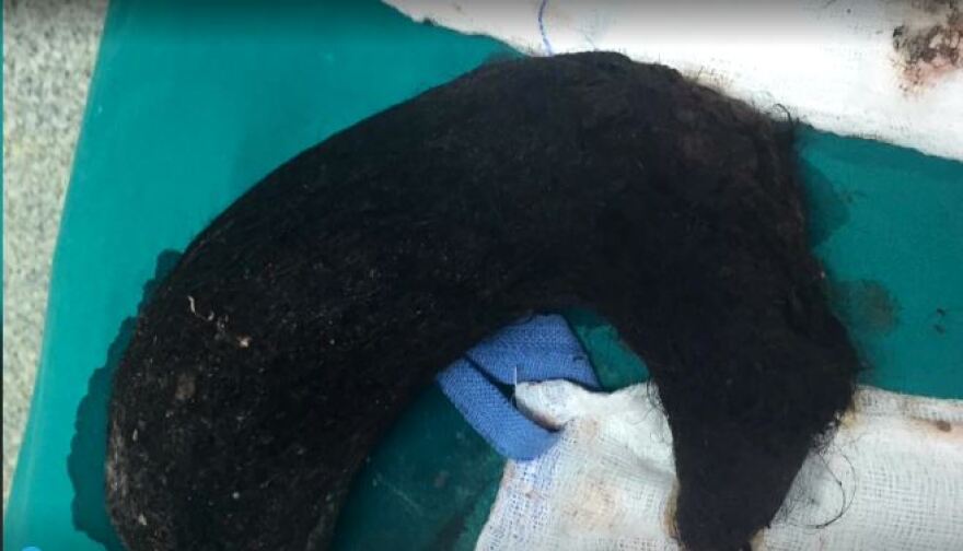 Βίντεο: Δείτε τη μάζα από τρίχες που αφαίρεσαν από το στομάχι της 14χρονης - Τι λέει η γιατρός που τη χειρούργησε