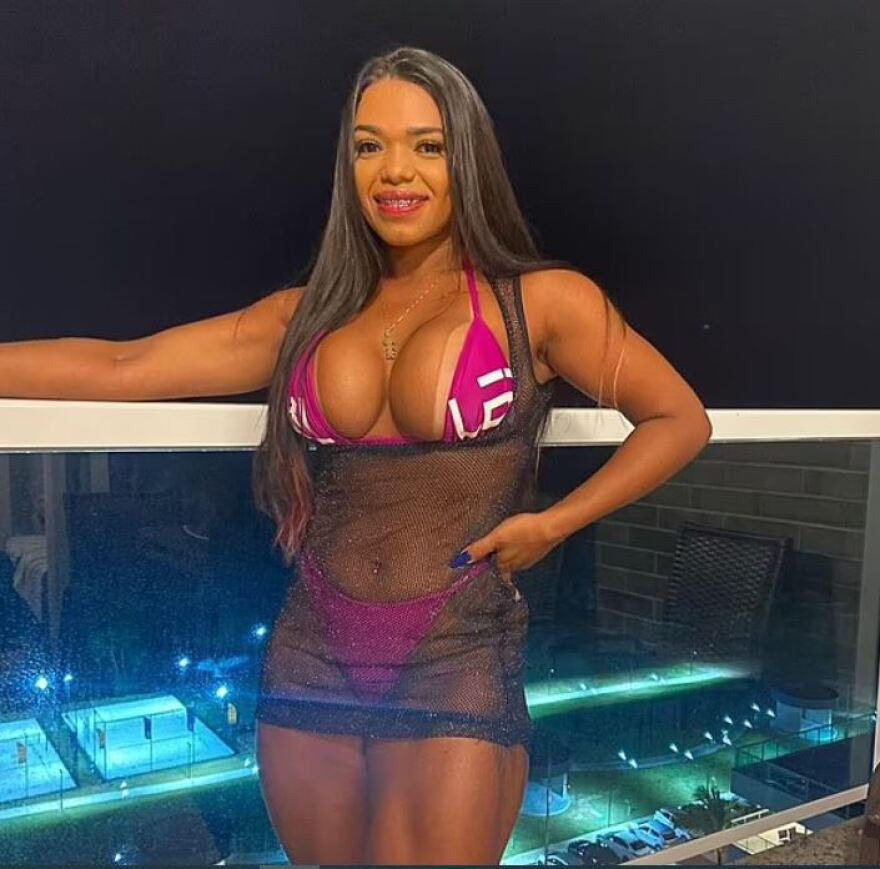 Βραζιλία: Τρομακτικό ατύχημα - Σέξι χορεύτρια τον χτύπησε με τα οπίσθια και εξαρθρώθηκε ο αγκώνας του