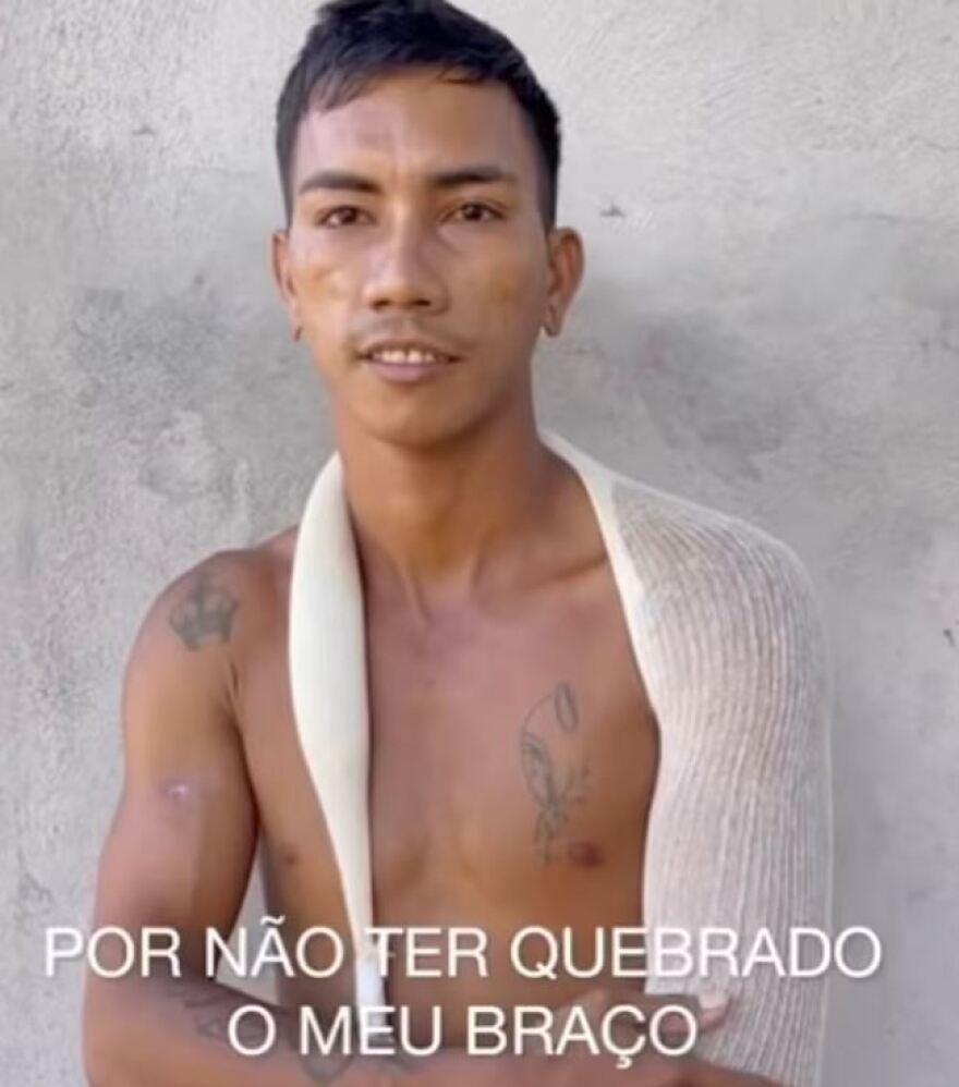 Βραζιλία: Τρομακτικό ατύχημα - Σέξι χορεύτρια τον χτύπησε με τα οπίσθια και εξαρθρώθηκε ο αγκώνας του