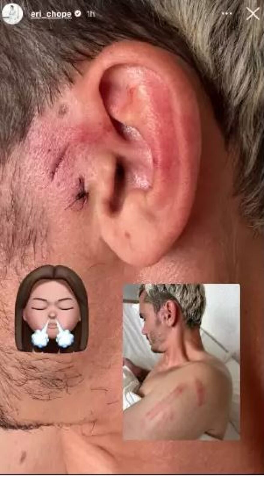 Αντουάν Γκριεζμάν: Έξαλλη η σύζυγός του με τα σημάδια από την «καρατιά» του Μαυροπάνου 