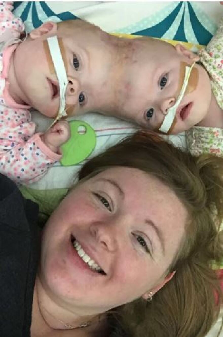 Σιαμαία που χωρίστηκαν κατάφεραν να τελειώσουν το νηπιαγωγείο - Είχαν 2% πιθανότητα επιβίωσης