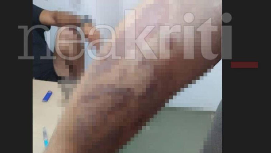 Κρήτη: Εγκαύματα β' βαθμού υπέστη 22χρονος που δούλευε ανασφάλιστος σε εστιατόριο ξενοδοχείο - Έπεσε πάνω του καυτό λάδι