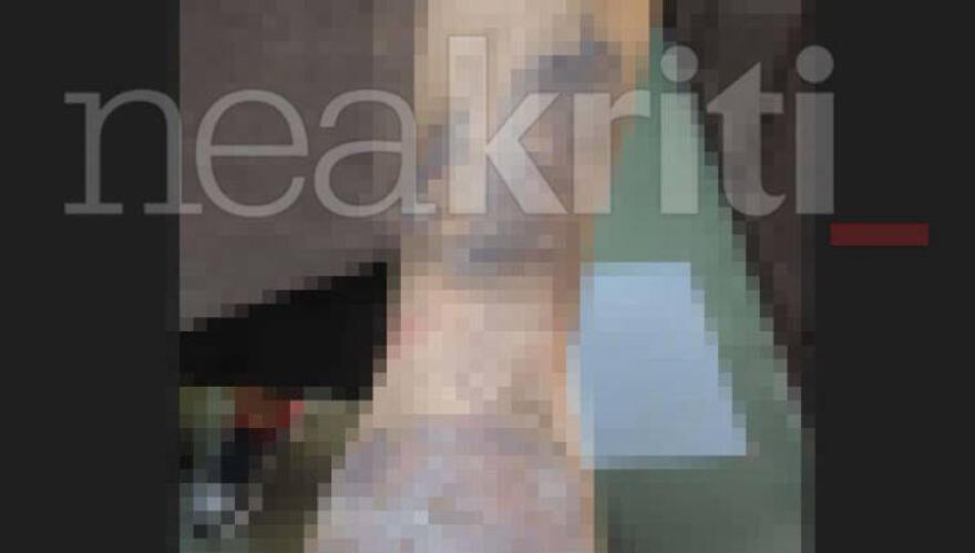 Κρήτη: Εγκαύματα β' βαθμού υπέστη 22χρονος που δούλευε ανασφάλιστος σε εστιατόριο ξενοδοχείο - Έπεσε πάνω του καυτό λάδι