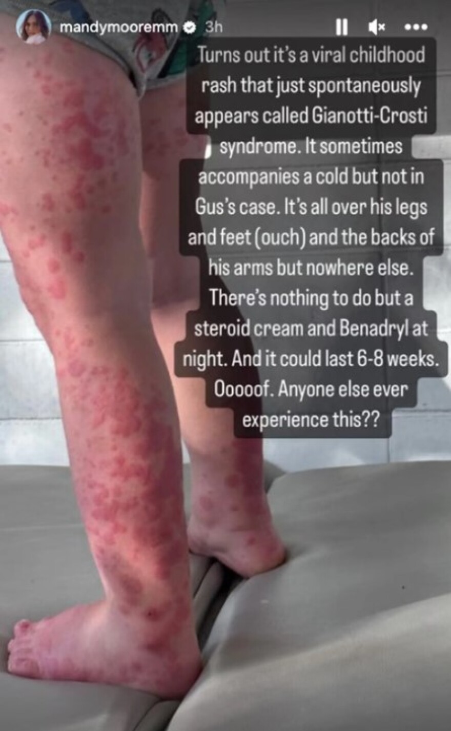 Μάντι Μουρ: Ο 2χρονος γιος της διαγνώστηκε με το σύνδρομο Gianotti-Crosti 