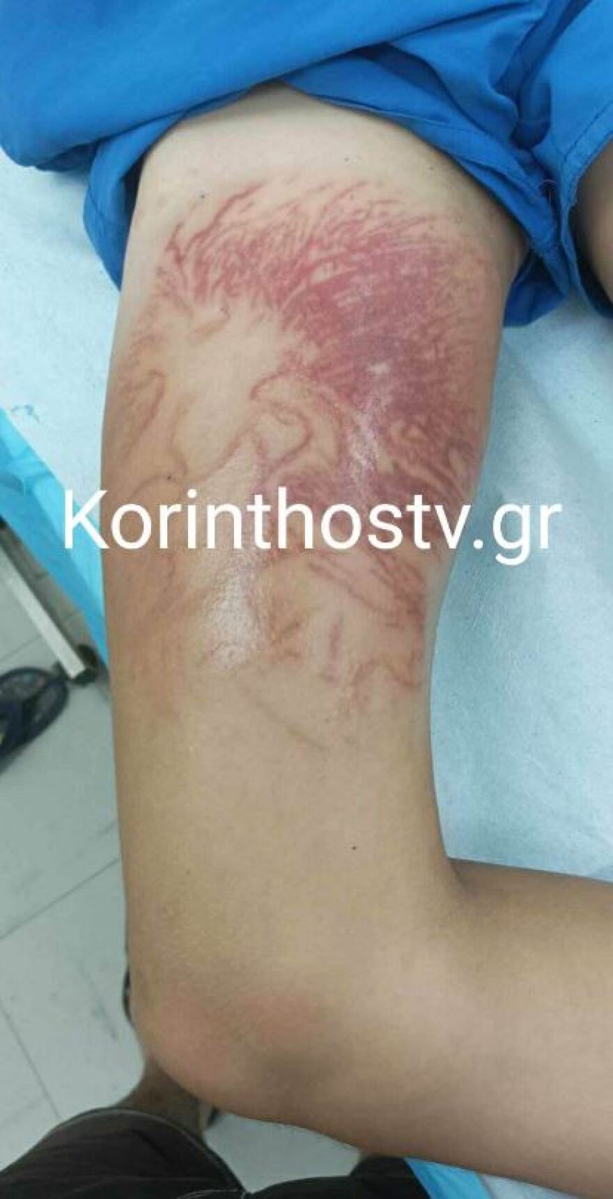 Κόρινθος: Στο νοσοκομείο 9χρονος, τον τσίμπησε θαλάσσια ανεμώνη - Δείτε φωτογραφία