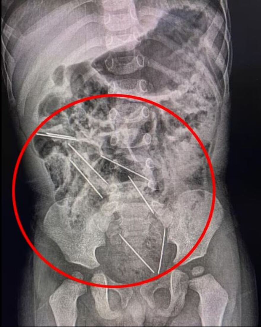 Περού: 2χρονος κατάπιε οκτώ βελόνες που προορίζονταν για ενέσεις σε ζώα - Ζει από θαύμα