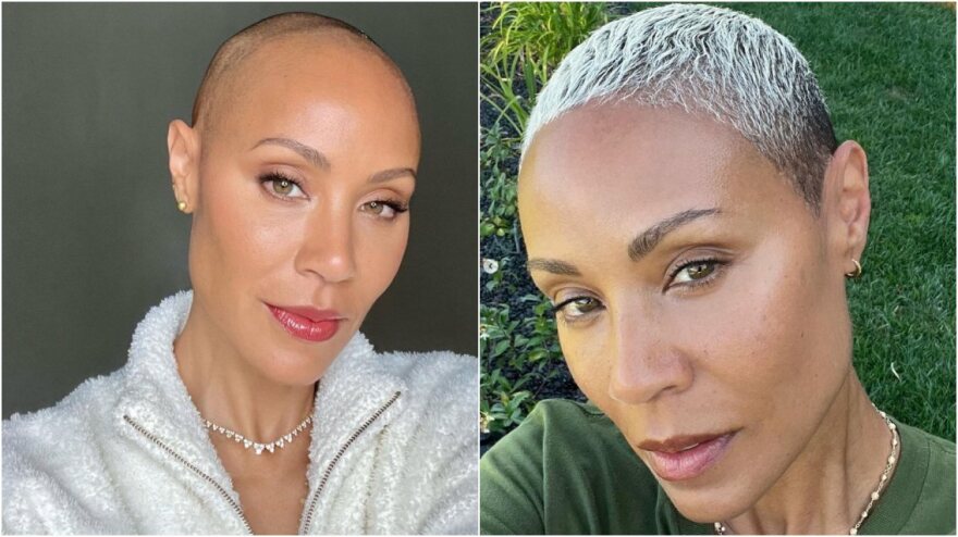 H Τζέιντα Πίνκετ Σμιθ αποκάλυψε πως το πρόβλημα της αλωπεκίας έχει βελτιωθεί σημαντικά