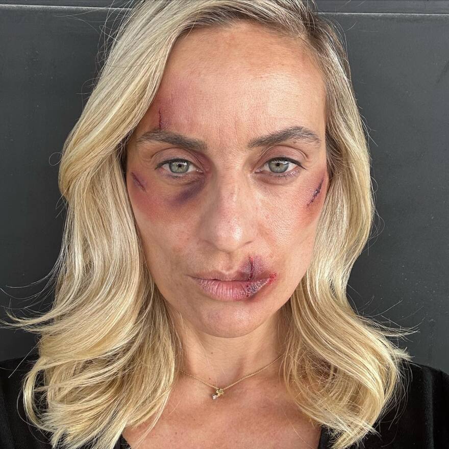 Ελεονώρα Μελέτη: Φωτογραφίζεται ως θύμα ξυλοδαρμού και μιλά για την κακοποίηση