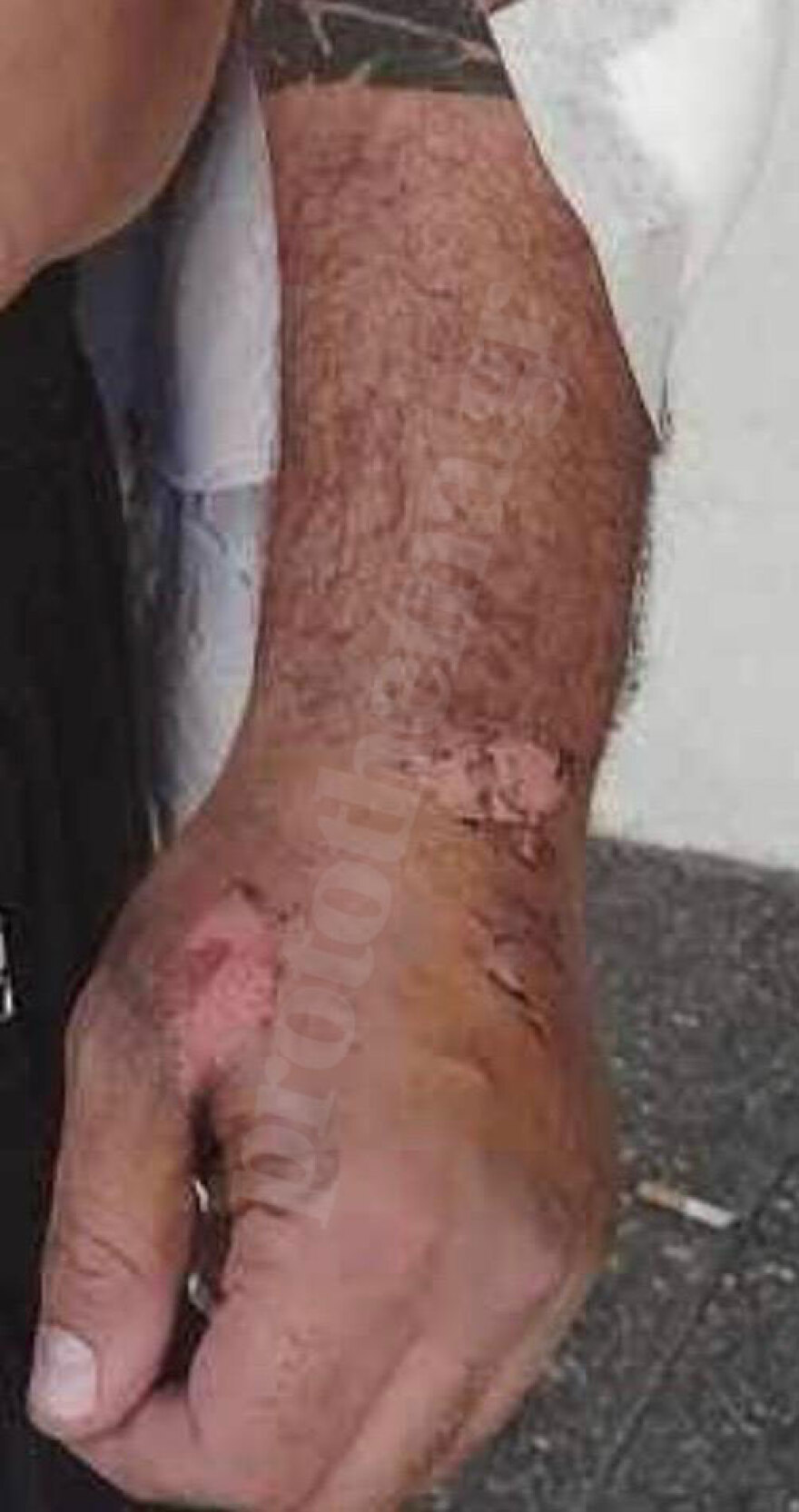 Θεσσαλονίκη - Καταγγελία: «Τον χτυπούσαν 12 άτομα με τέιζερ και αλυσίδες και η ΕΛΑΣ δεν του έχει πάρει ακόμα κατάθεση»